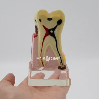 Extinsă Dintii Bolnave Model Saprodontia Dinte Cariat Nervului Dentar Orală Anatomice Model Educațional Echipamente Instrument De Predare